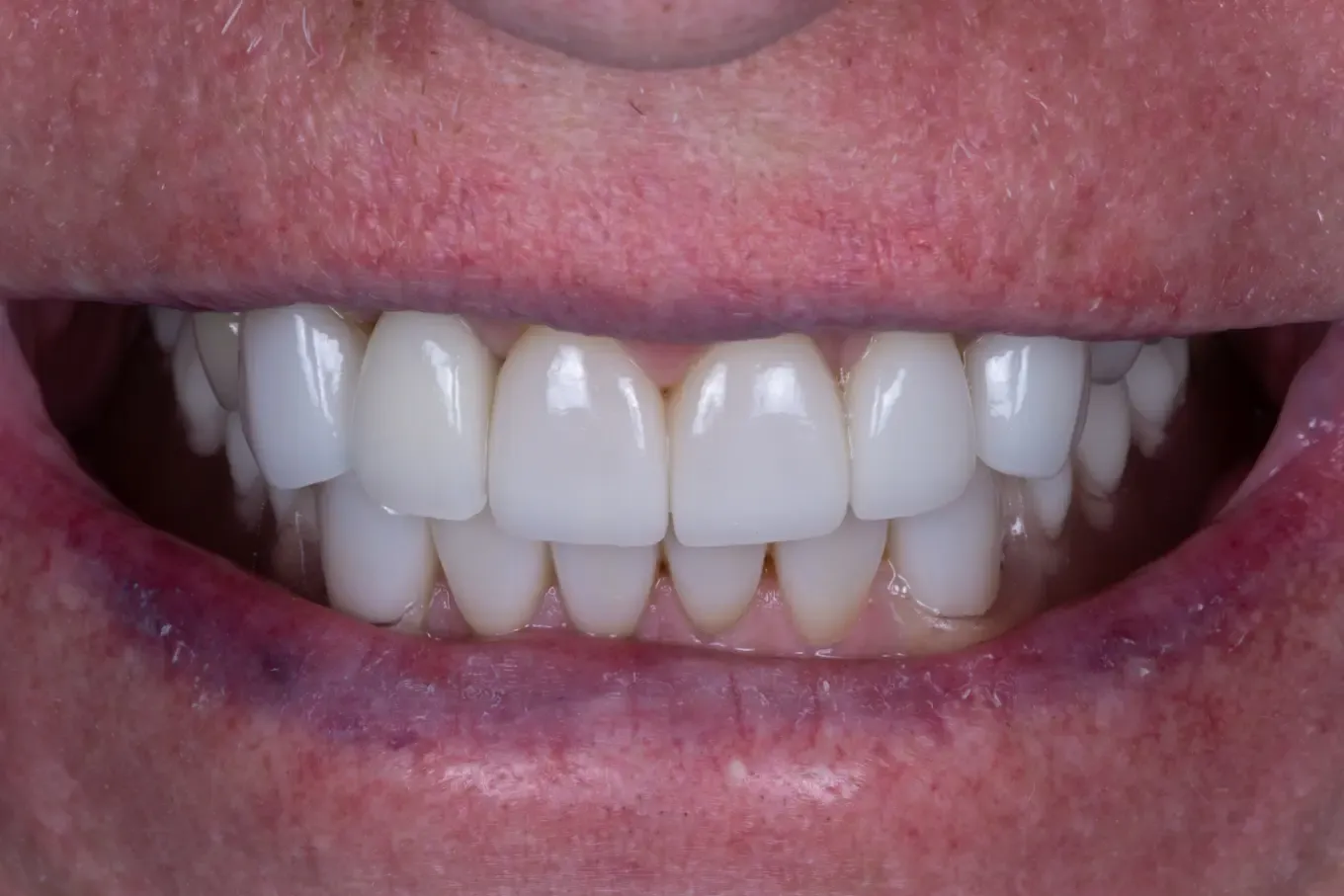 A brighter, more even smile — after treatment