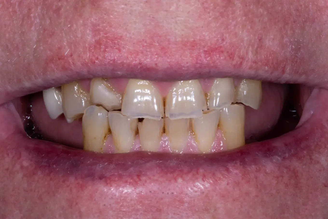 A brighter, more even smile — before treatment