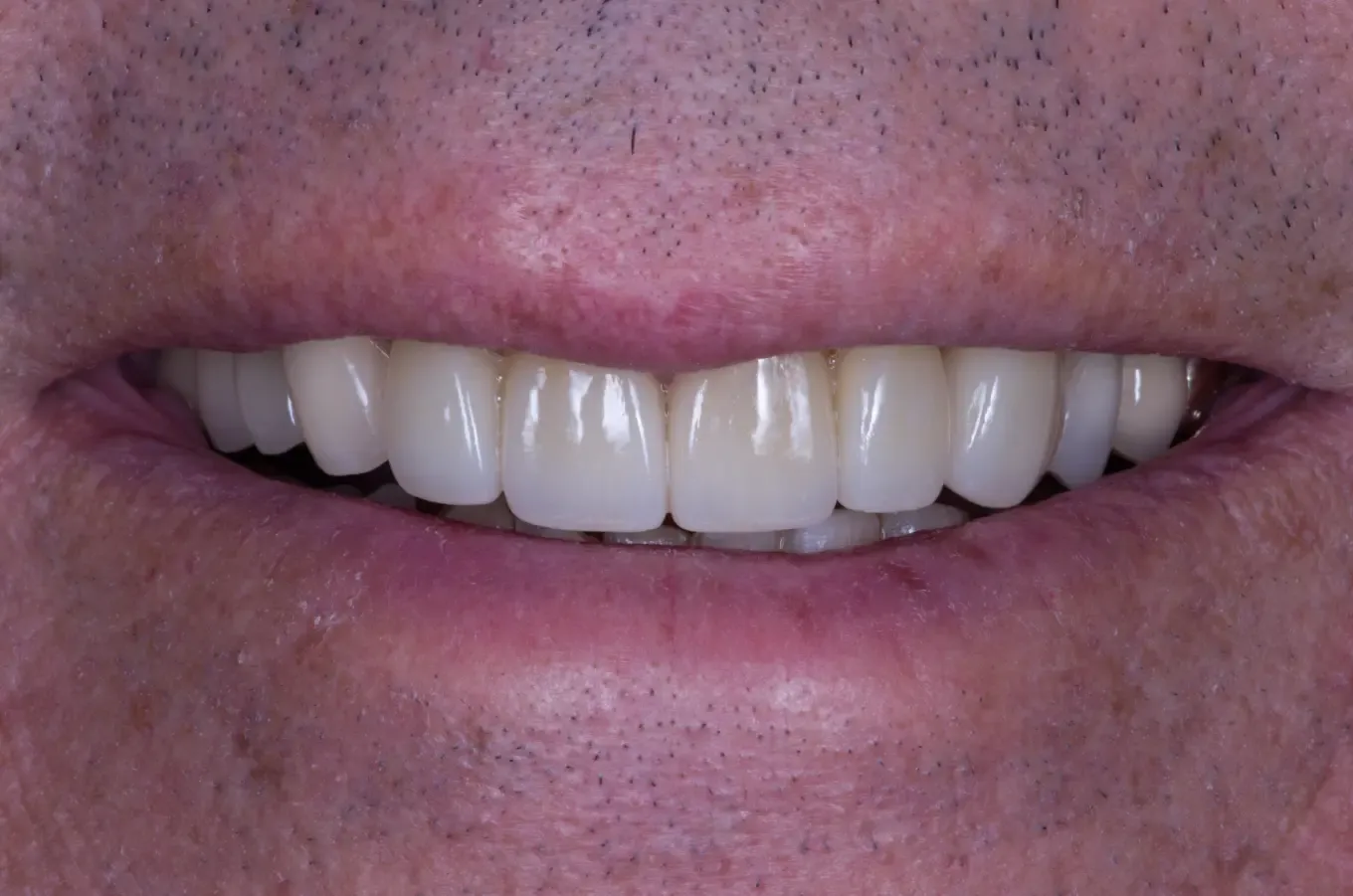 After full mouth rehabilitation