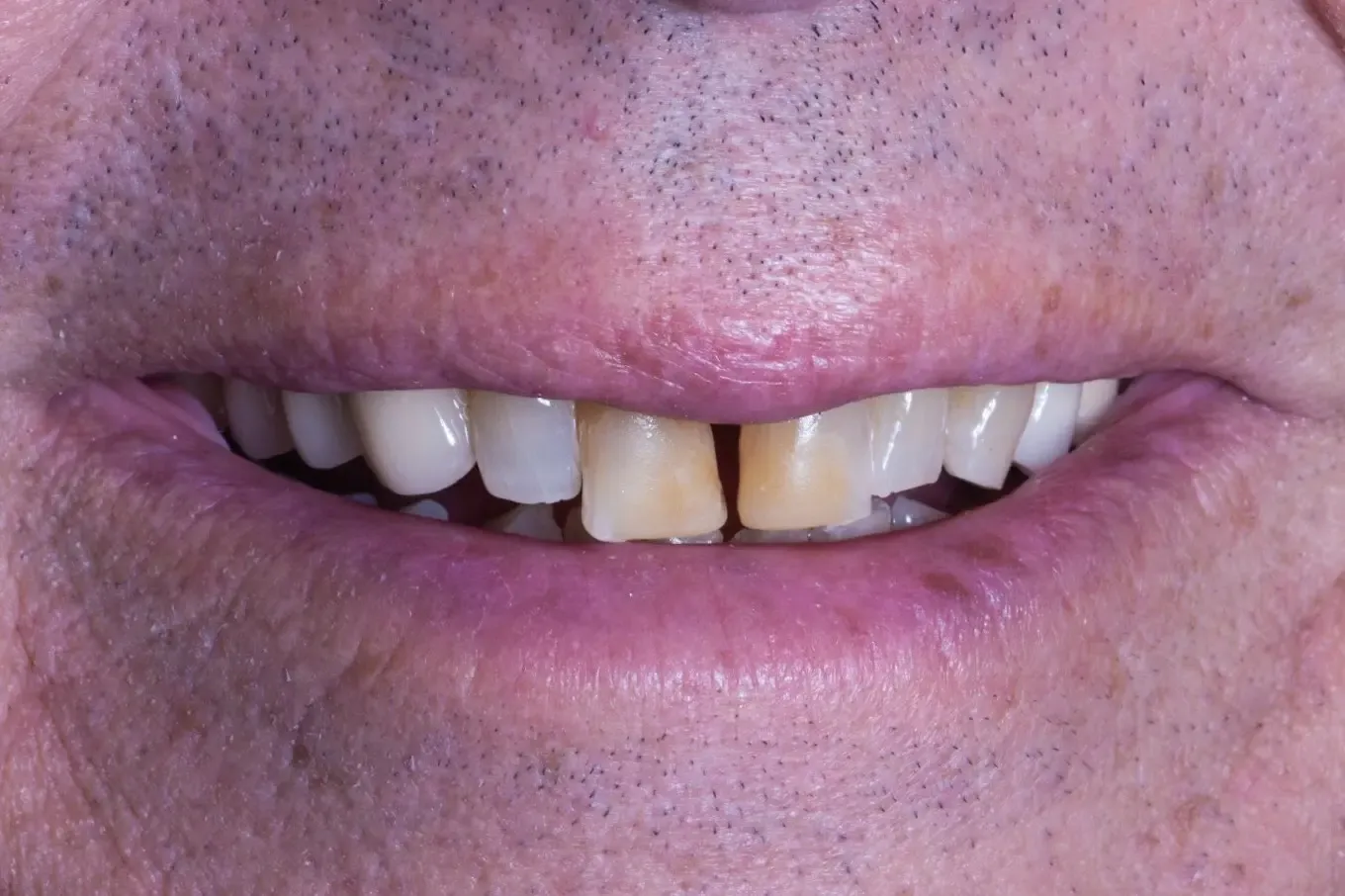 Before full mouth rehabilitation